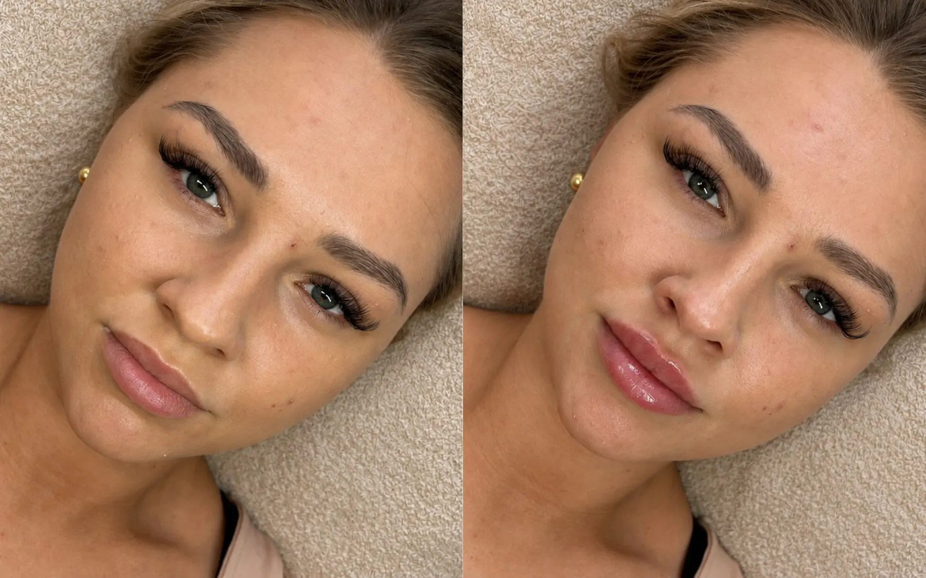 Lip enhancement result