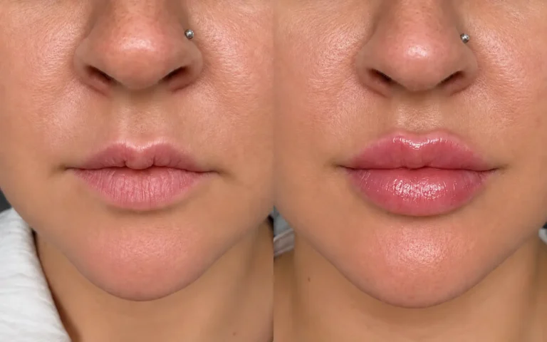 Before and after close-up of lips
