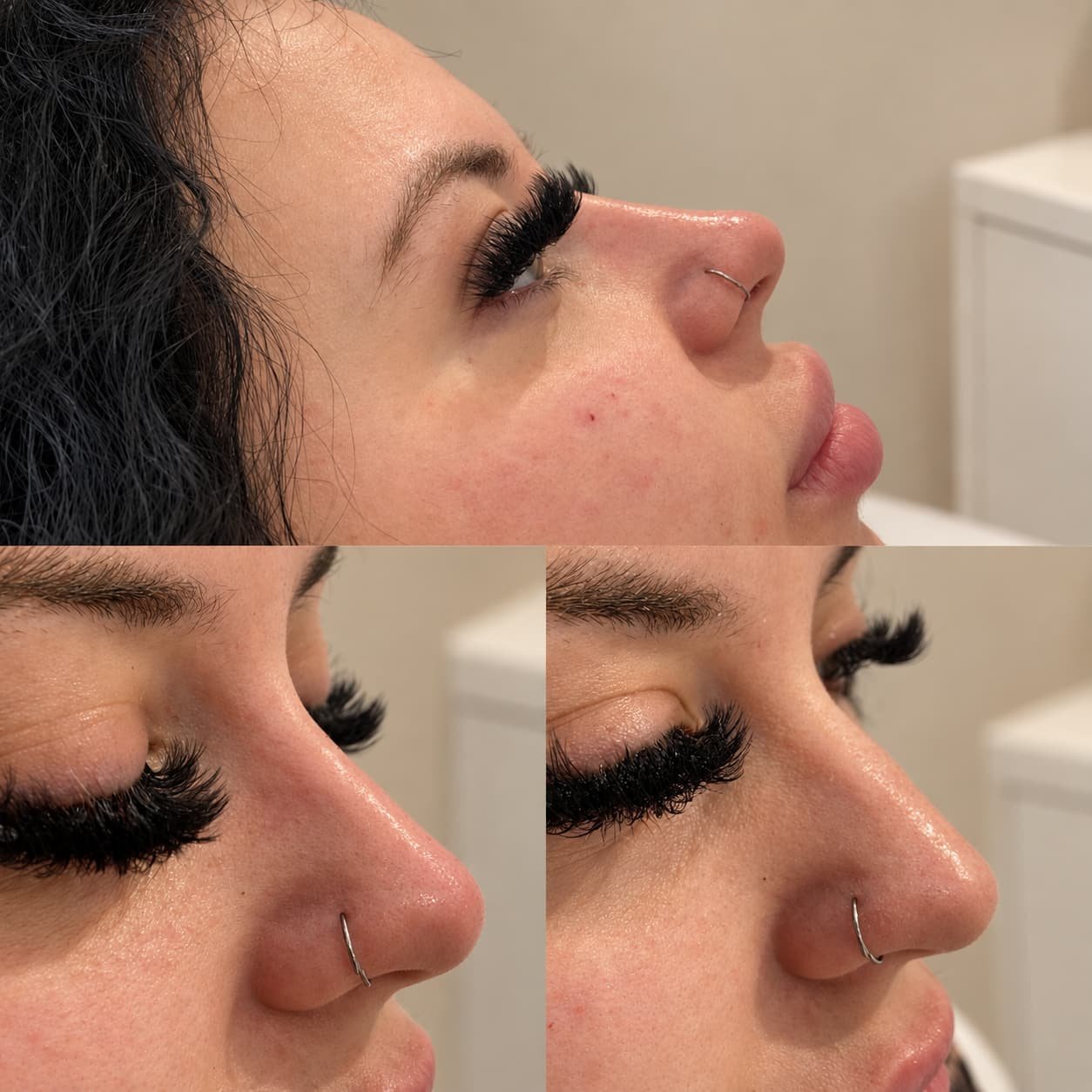 Profile enhancement treatment at Alixir Aesthetics