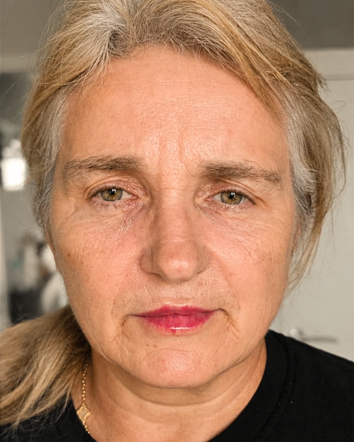 Full face treatment after