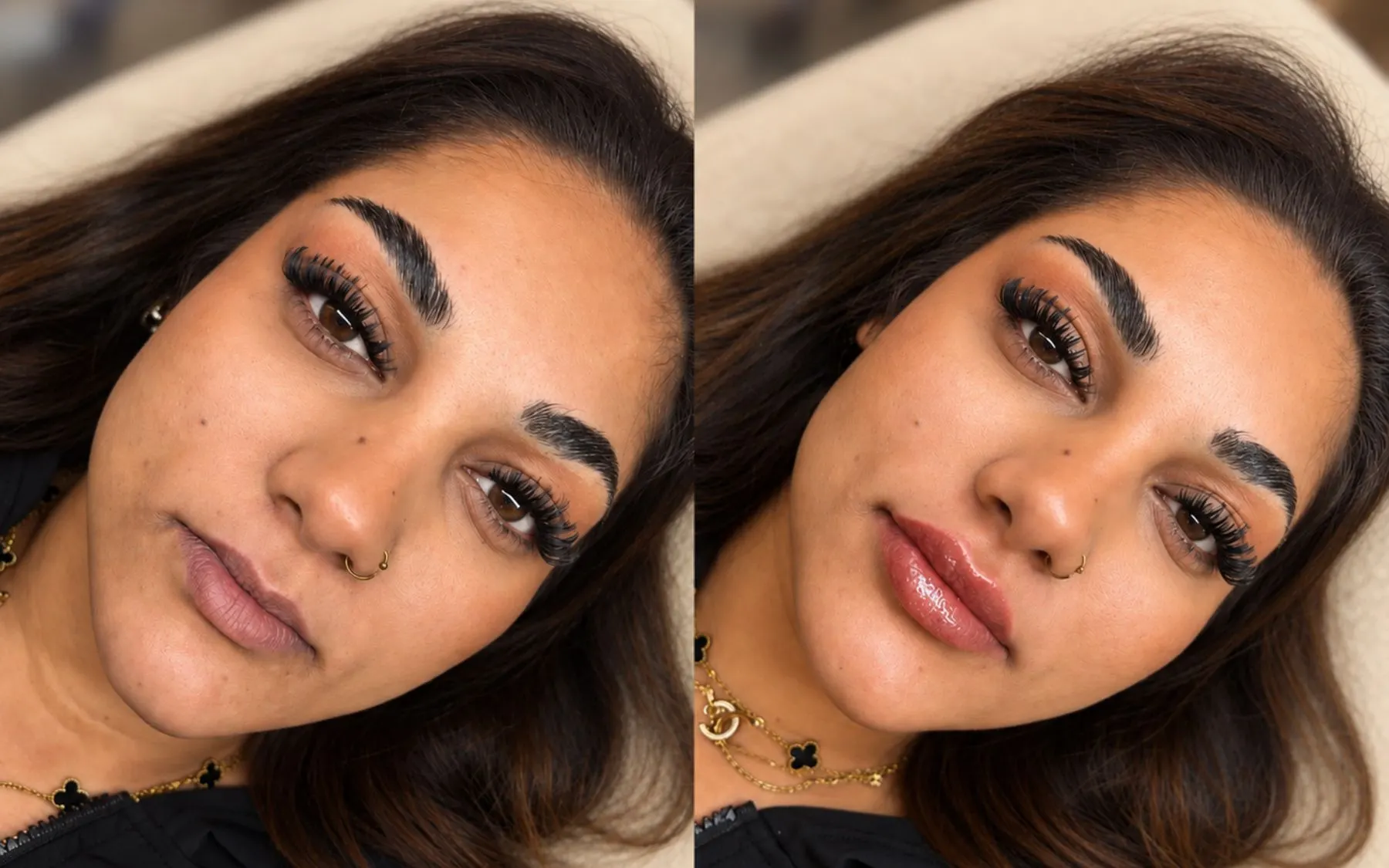 Lip enhancement before and after result