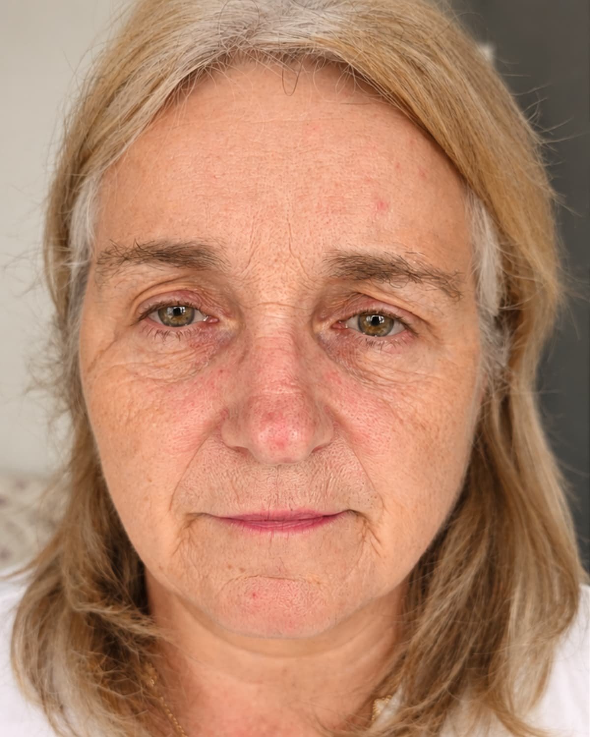 Full face treatment before
